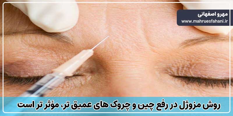 مقایسه هایفوتراپی و مزوژل برای رفع چین و چروک های عمیق