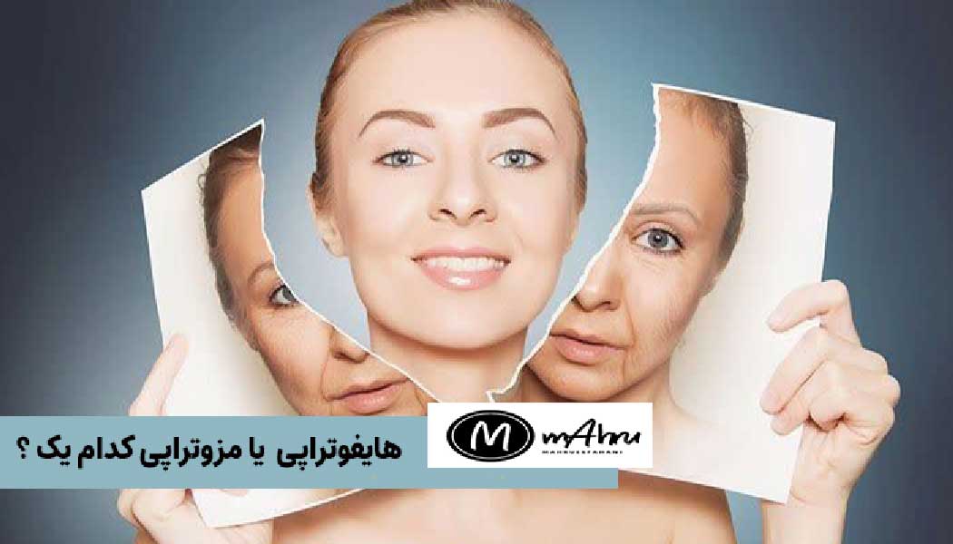 هایفوتراپی بهتر است یا مزوژل