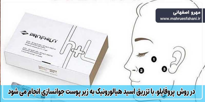 تفاوت هایفو با مزوژل و پروفایلو