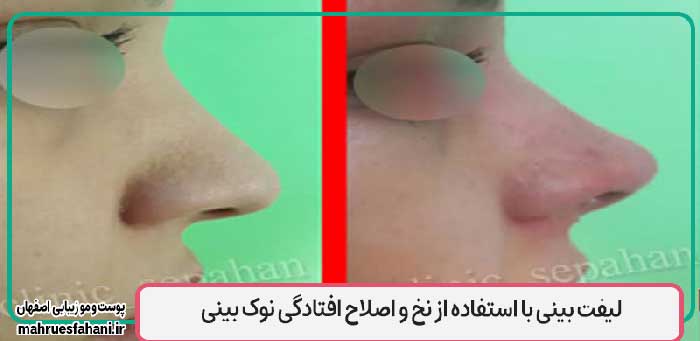 خدمات لیفت با نخ کلینیک سپاهان اصفهان