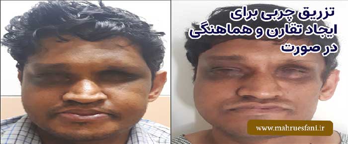 قبل و بعد تزریق چربی به صورت جهت تقارن سازی