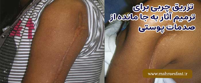 قبل و بعد از تزریق چربی به بدن توسط جراح پلاستیک برای ترمیم