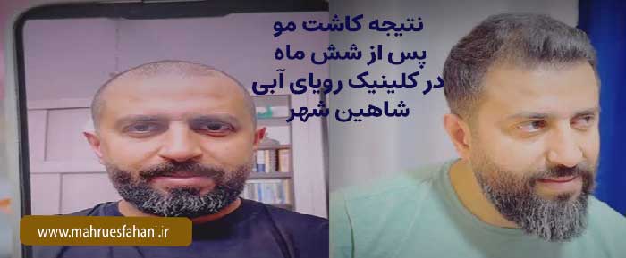 خدمات کاشت مو کلینیک رویای آبی شاهین شهر