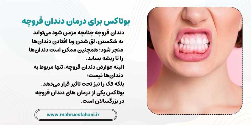 بوتاکس دندان و درمان دندتن قروچه