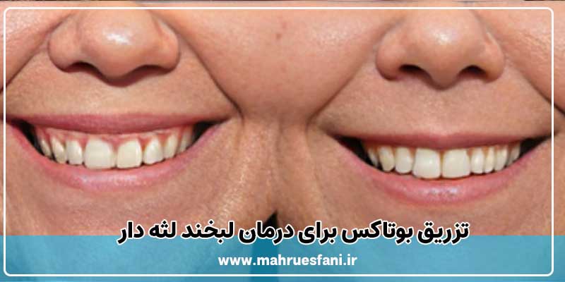 بوتاکس در دندانپزشکی برای درمان لبخند لثه دار