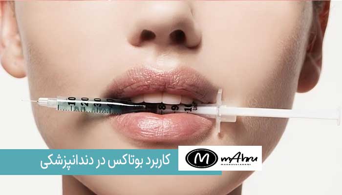 کاربردهای بوتاکس در دندانپزشکی