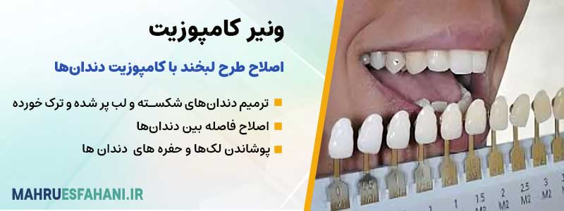 خدمات ونیر کامپوزیت دکتر محمد عاطفت اصفهان