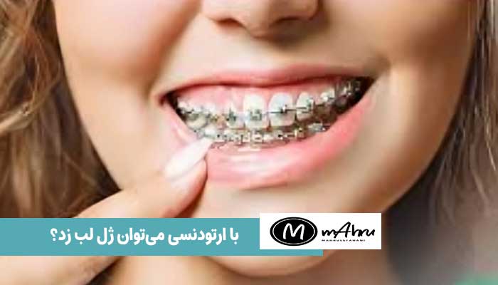 تزریق ژل لب با ارتودنسی