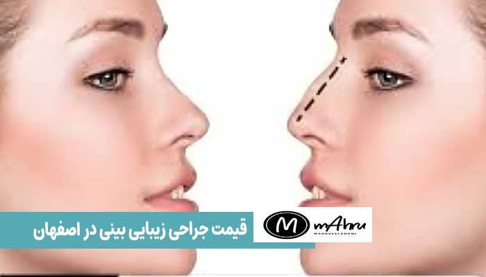 هزینه عمل بینی گوشتی یا استخوانی در اصفهان