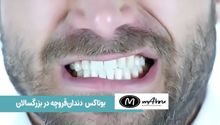 چگونه با بوتاکس دندان قروچه درمان می‌شود؟