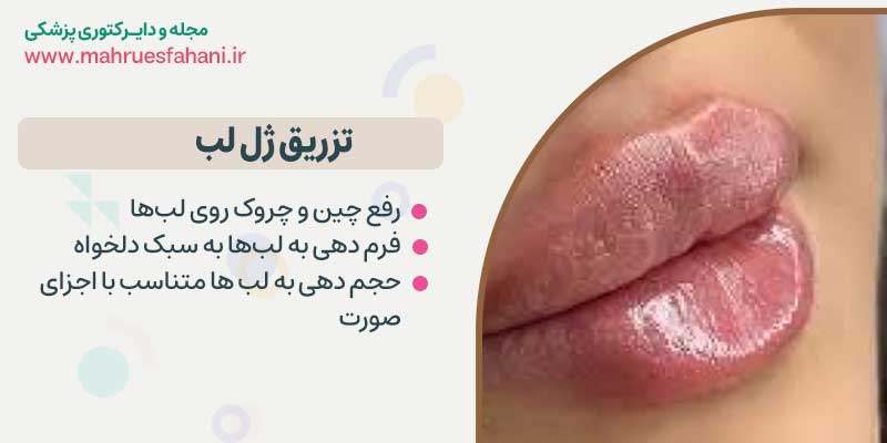 بهترین دکتر تزریق زل لب روسی در اصفهان