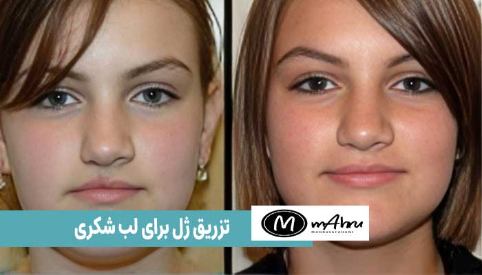 تزریق ژل برای لب شکری یا لب شکافته