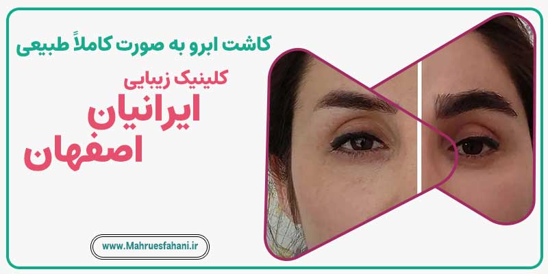 خدمات کاشت ابرو طبیهی در کلینیک کاشت موی ایرانیان اصفهان
