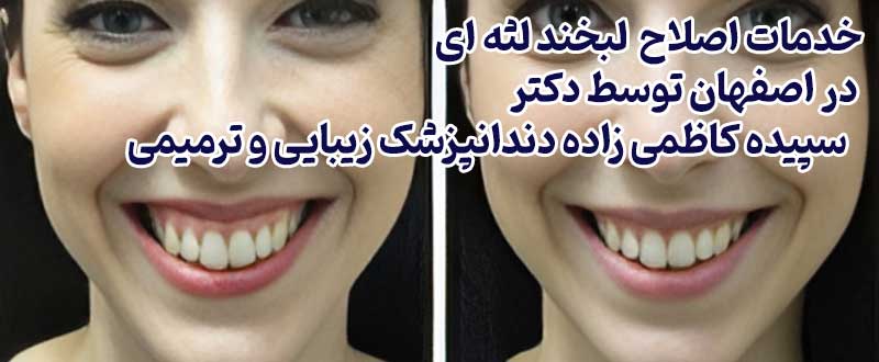 آیا بوتاکس لبخند لثه ای توسط دندانپزشک انجام می‌شود؟