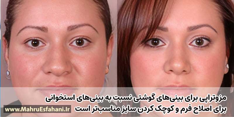 عکس مزوتراپی بینی گوشتی قبل و بعد