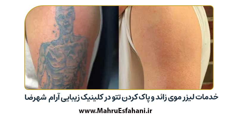 کلینیک زیبایی آرام خدمات لیزر تتو و موی زائد در شهرضا