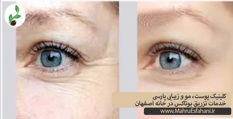 کلینیک پارسی خدمات بوتاکس در خانهاصفهان