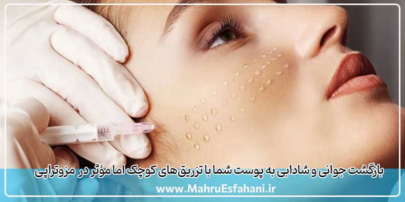مزوتراپی برای پوست صورت