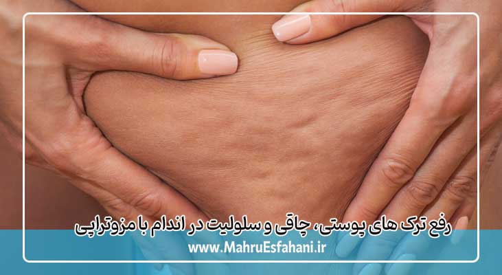 مزوتراپی و درمان سلولیت ساق پا و چاقی ران