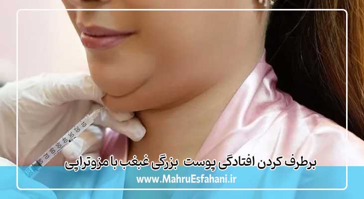 مزوتراپی برای رفع غبغب