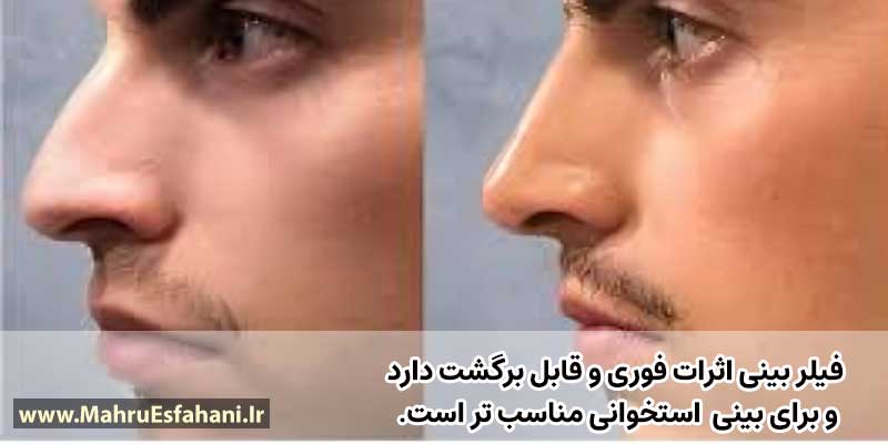 عکس قبل و بعد فیلر بینی استخوانی و گوشتی 