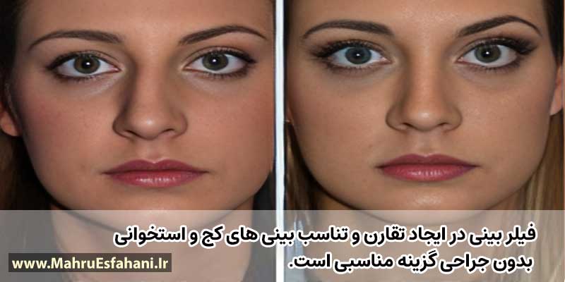 آیافیلر بینی خوبه؟فیلر بینی استخوانی چگونه است؟