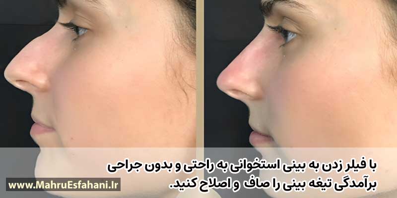 عکس فیلر بینی از روبرو و جلو
