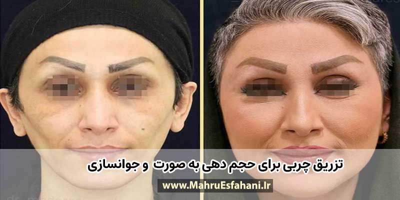 عکس قبل و بعد از تزریق چربی به صورت