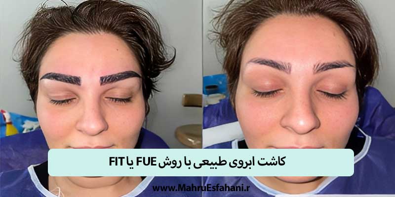 کاشت ابرو  نچرال و طبیعی با روش FUT یا fue