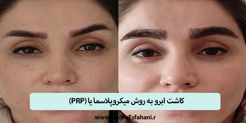 کاشت ابرو به روش پانچ،میکروپلاسما و میکروفیت