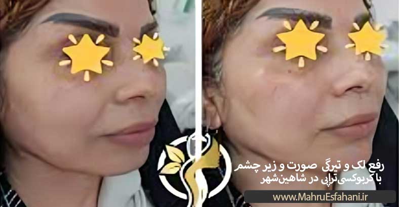 دکتر مهرناز ناظری خدمات کربن تراپی صورت واژن و بدن در شاهین شهر اصفهان