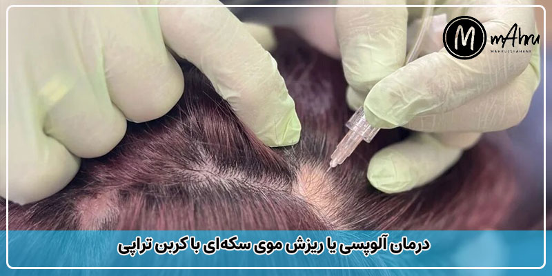 برای ریزش مو آیا کربوکسی تراپی تأثیر دارد؟