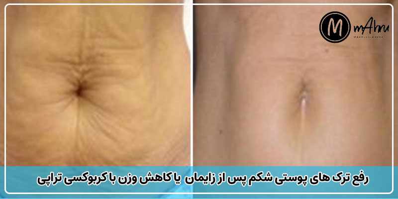 عکس قبل و بعد از کربوکسی تراپی شکم