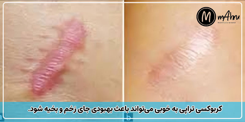 عکس قبل و بعد از کربوکسی تراپی برای جای بخیه و جای زخم
