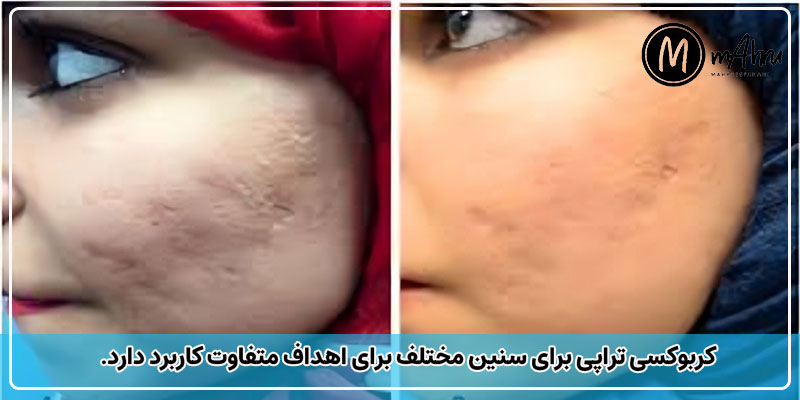 از چه سنی می توان کربوکسی تراپی را انجام داد؟ لیزر CO2 برای چه سنی است؟
