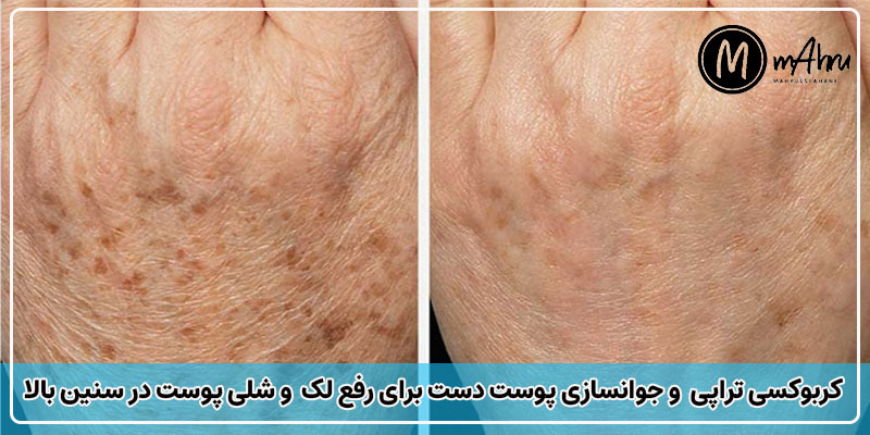 جوانسازی دست با کربوکسی تراپی چه جوریه؟