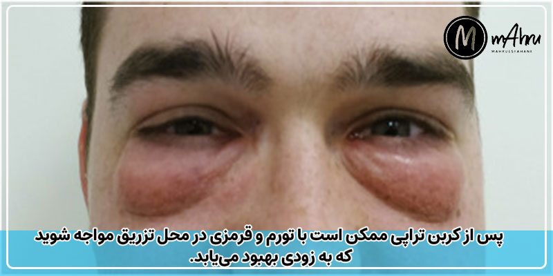 آیا کربوکسی تراپی عوارض دارد؟