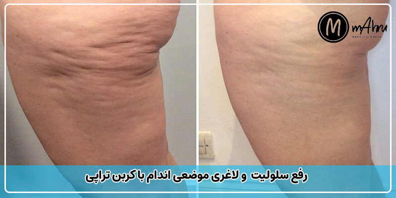 کربوکسی تراپی پا و رفع سلولیت و لاغری ران
