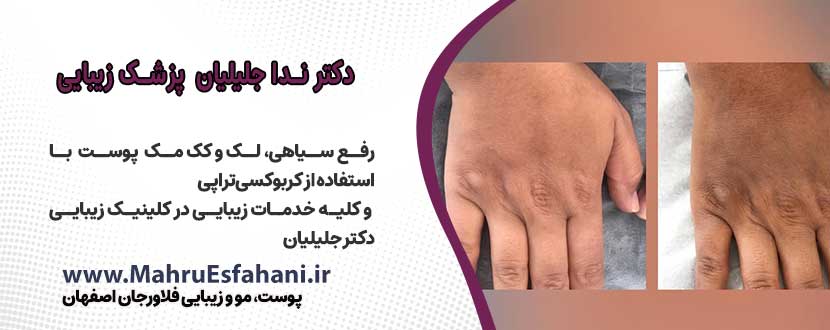 دکتر ندا جلیلیان دکتر پوست فلاورجان اصفهان