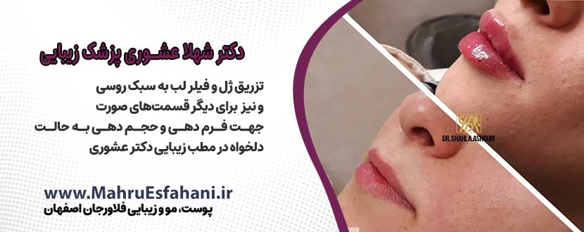 دکتر پوست و مو دکتر شهلا عشوری فلاورجان