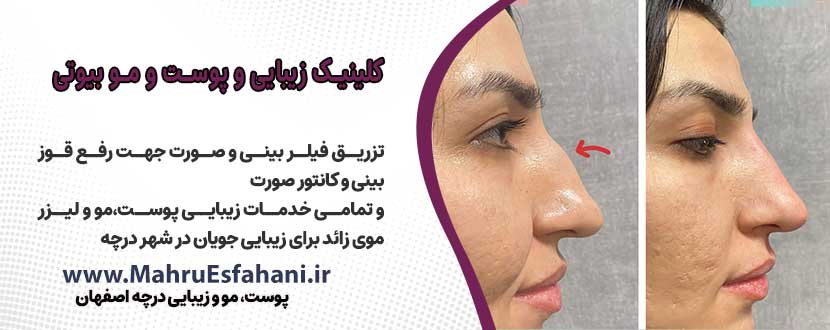 تزریق فیلر بینی برای رفع قوز و خدمات زیبایی پوست و مو در بیوتی کلینیک درچه