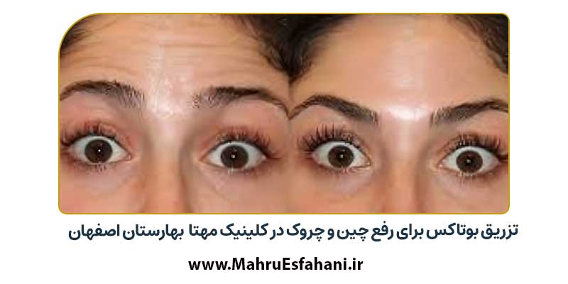 تزریق بوتاکس و ژل و فیلر توسط دکتر پوست شهرستان بهارستان
