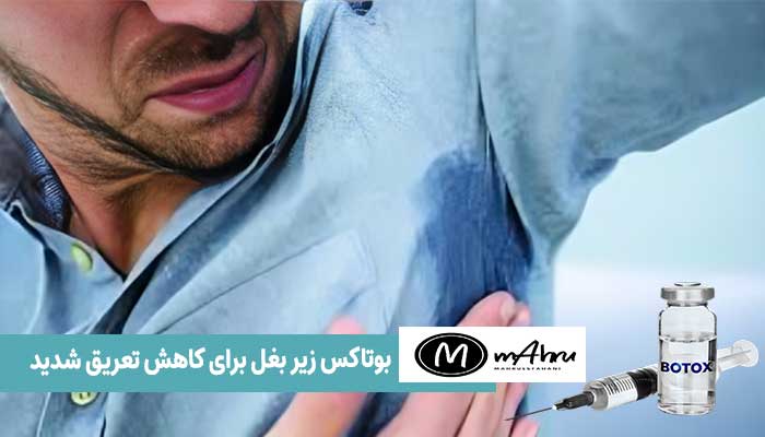 بوتاکس زیر بغل و کف دست