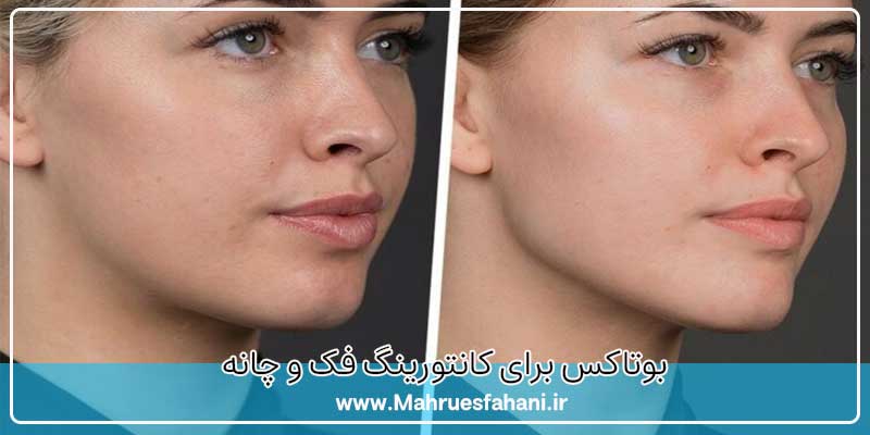 بوتاکس برای زاویه سازی و کانتوینگ صورت