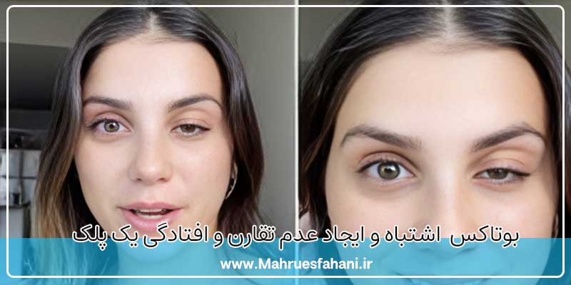 بوتاکس صورت و افتادگی پلک و ابرو پس از آن