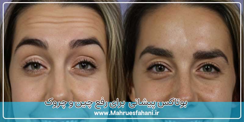 عکس قبل و بعد از بوتاکس پیشانی