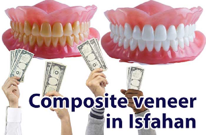 قیمت پرکردن دندان خراب یا طرح لبخند با کامپوزیت در اصفهان