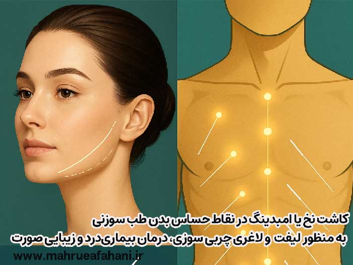کاشت نخ در نقاط حساس بدن طب سنتی چینی برای لاغری و زیبایی