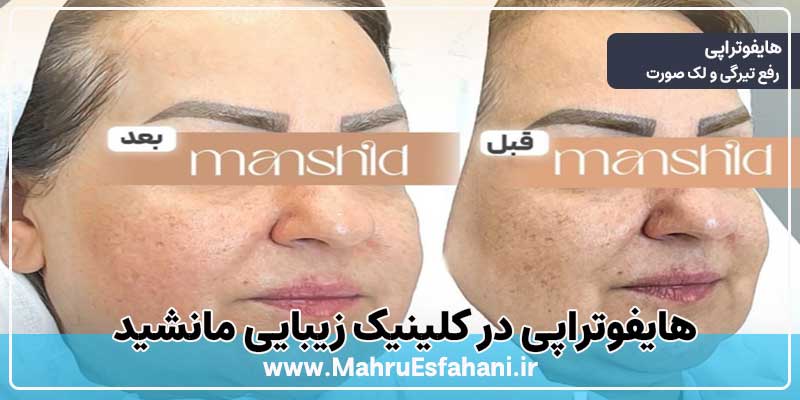 خدمات هایفوتراپی در کلینیک مانشید دکتر مینا دادگر