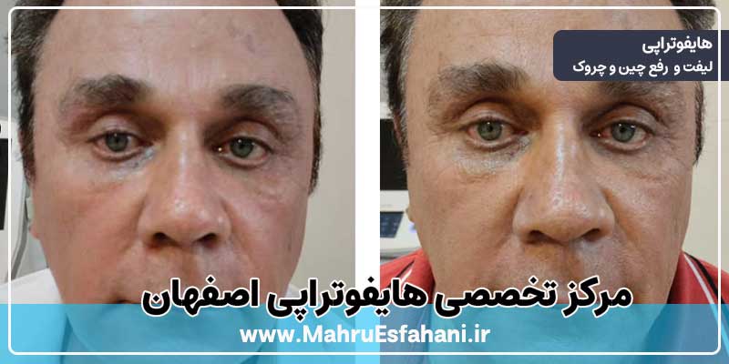 خدمات هایفوتراپی در مرکز تخصصی هایفو اصفهان